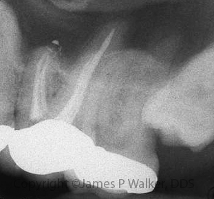 Maxillary Molar